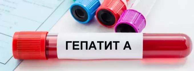 Гепатит А в Харкові - зафіксовано 4 випадки: причини та симптоми