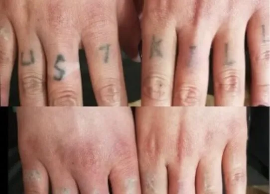 Як видалити тату без шрамів? Досвід TST: сучасні методи та догляд